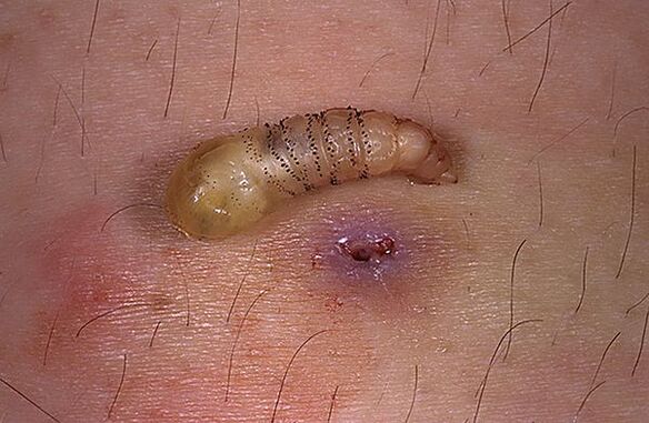 parásito larva subcutánea de humanos